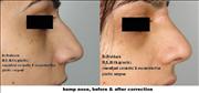 before after,nose  hump nose